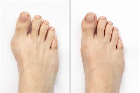 ayaklarda deforme olan artroz 2. derece tedavi